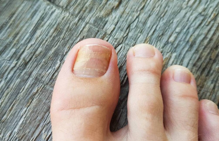 Try One of These 10 Toenail Fungus Home Remedies