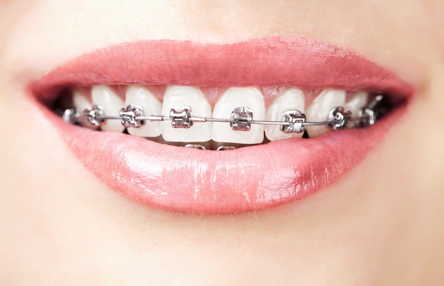 Advances in Orthodontic Wires and Brackets: Revolutionizing Smile Transformation