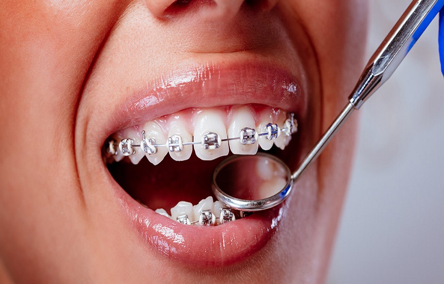 Invisalign vs Traditional Braces Redlands: Which is Right for You?