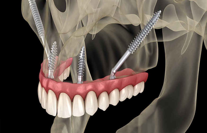 Zygomatic Dental Implants: A Revolutionary Solution for Complex Cases