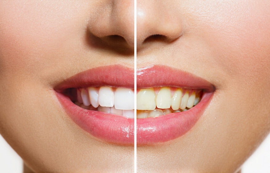 Smile Securely: Why Dental Implants Are Worth the Investment